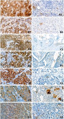 The prognostic value of stem cell markers in triple-negative breast cancer